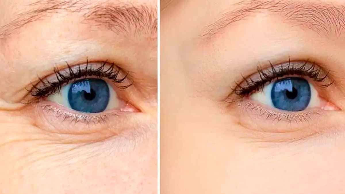 Beauté révélée : le bicarbonate, votre allié secret contre rides et cernes